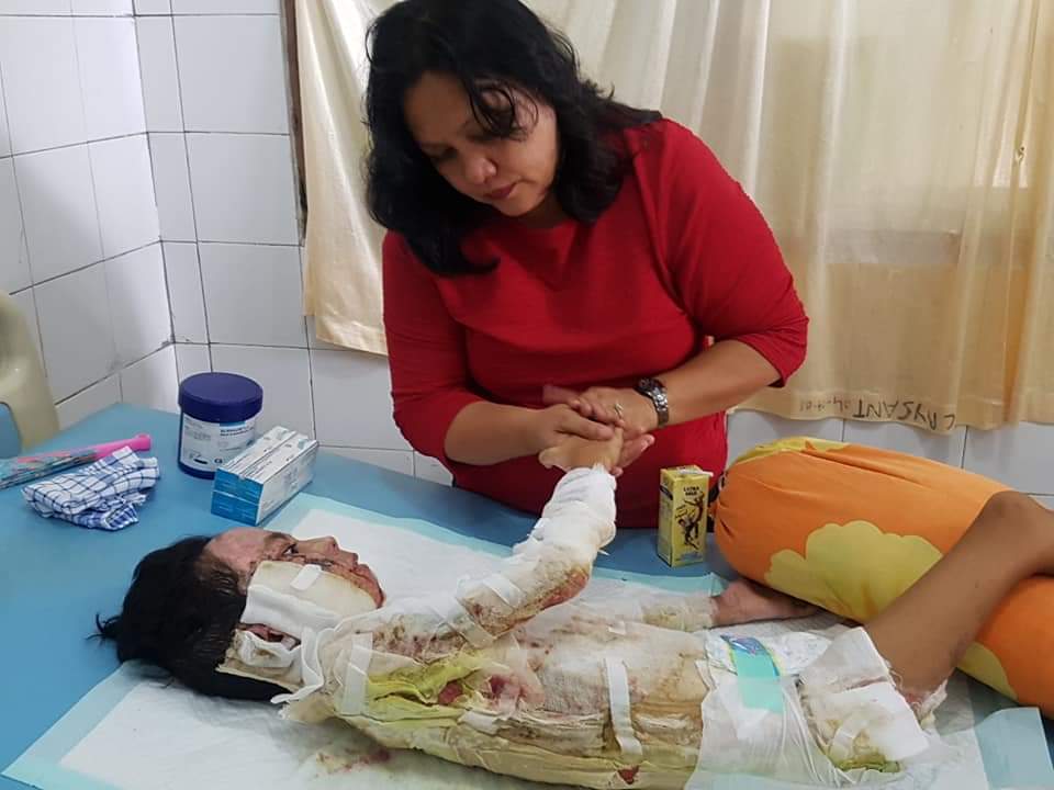 Miris, Siswi SD Ini Dibakar Ibu Kandungnya